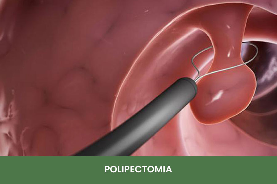La polipectomía es un procedimiento