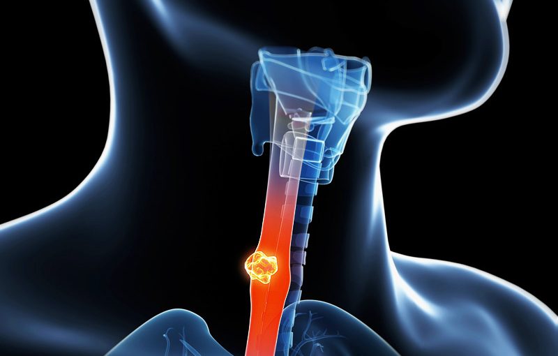 CÁNCER DE ESÓFAGO