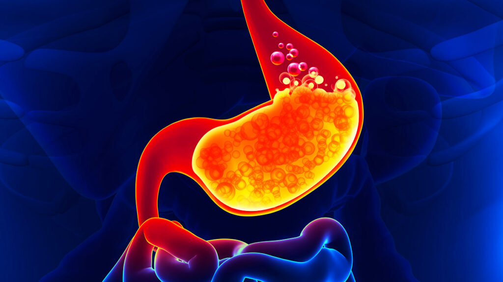 GASTRITIS-ENDOGASTRO-PUNO