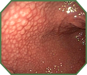 helicobacter pylori