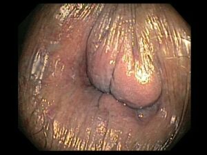 HEMORROIDAL PUNO
