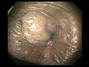HOMORROIDAL PUNO