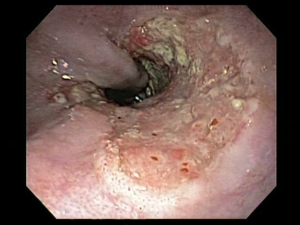 CÁNCER DE ESÓFAGO