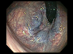 Hemorroides puno